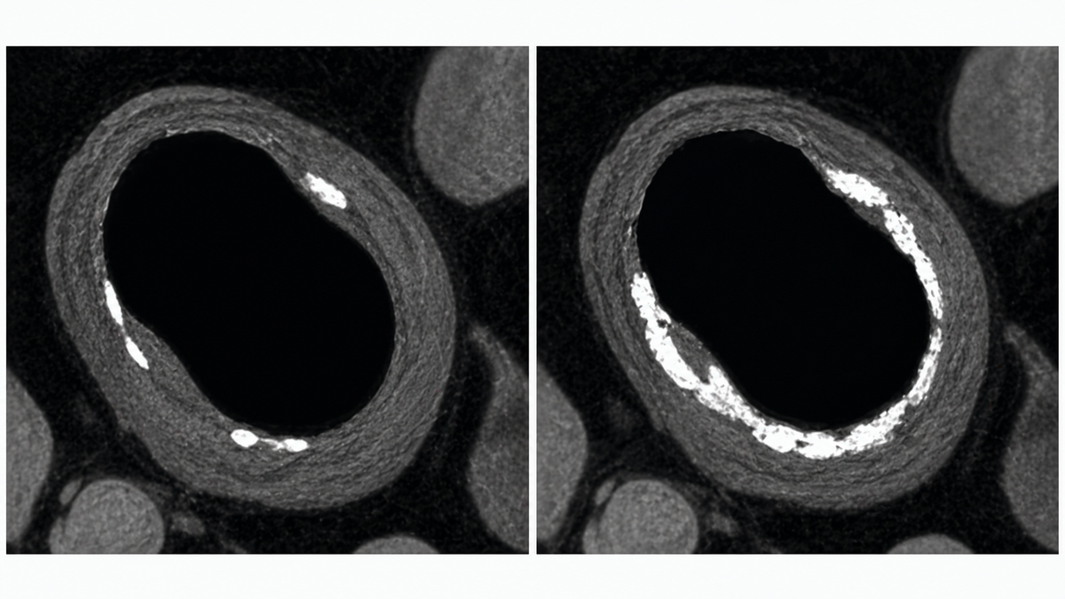 Before-and-after illustration of coronary calcium progression